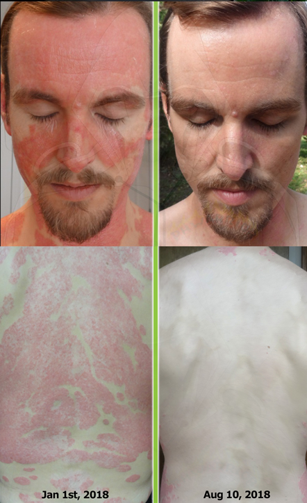 psoriasis before and after pictures